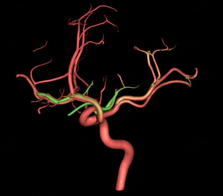 Vascular territory mapping in stroke imaging